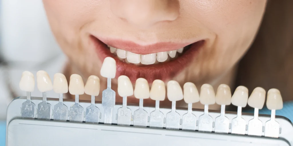 facettes dentaires veneers Soins dentaires Dr Pierre Mioche - Dentiste à Clermont-Ferrand