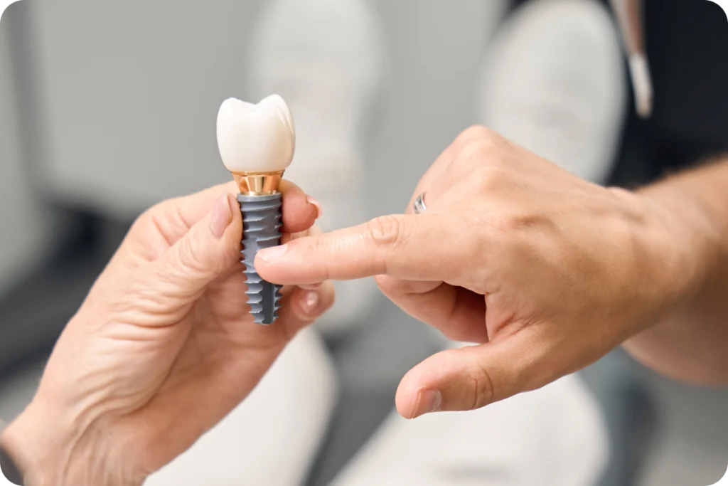 implant dentaire clermont ferrand implant dentaire clermont ferrand Implants dentaires unitaires Dr Pierre Mioche - Dentiste à Clermont-Ferrand