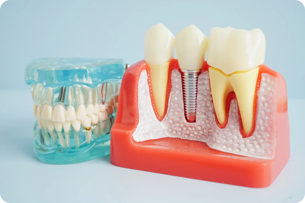 rdv dentiste implant dentaire clermont ferrand rdv dentiste implant dentaire clermont ferrand Implants dentaires unitaires Dr Pierre Mioche - Dentiste à Clermont-Ferrand