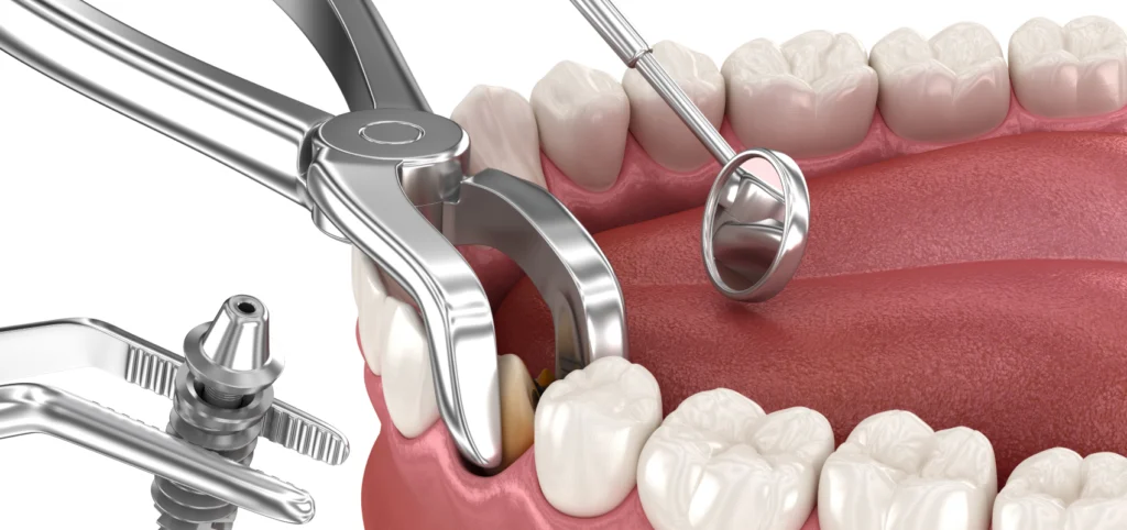 rdv dentiste implantation immediate clermont ferrand rdv dentiste implantation immediate clermont ferrand Implantation immédiate Dr Pierre Mioche - Dentiste à Clermont-Ferrand