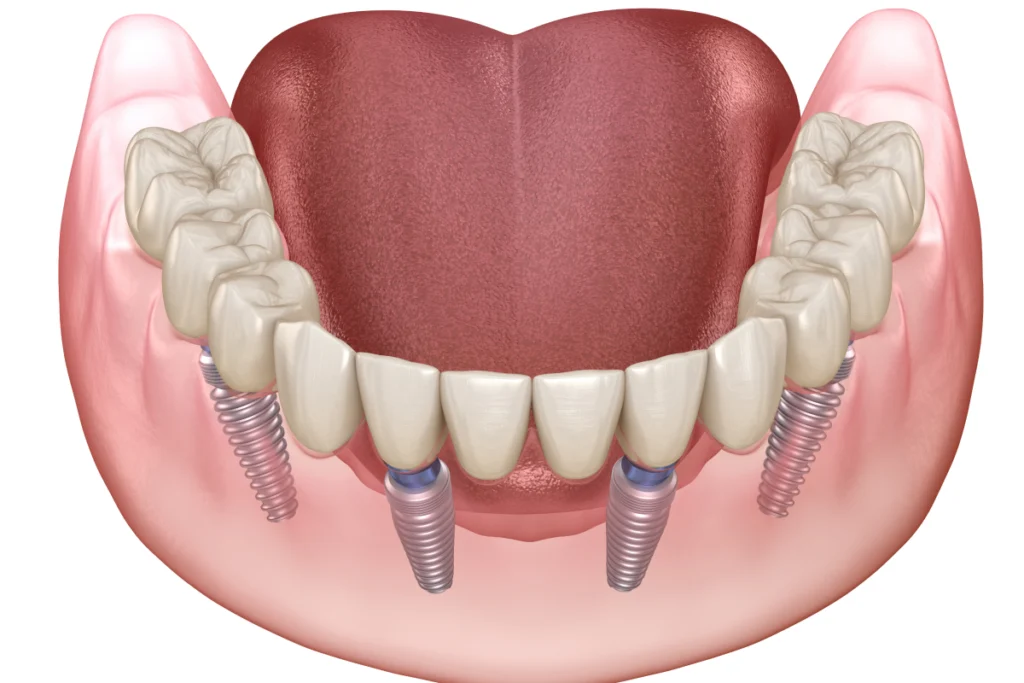 rdv implant complet clermont ferrand Implant complet Dr Pierre Mioche - Dentiste à Clermont-Ferrand