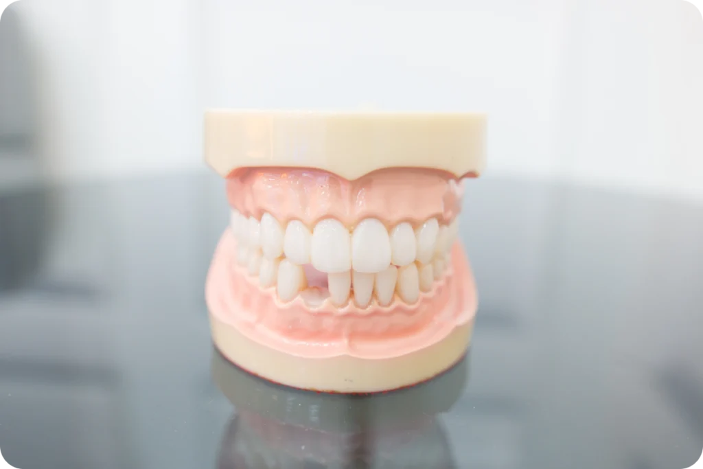 rdv implant dentaire clermont ferrand rdv implant dentaire clermont ferrand Implants dentaires unitaires Dr Pierre Mioche - Dentiste à Clermont-Ferrand