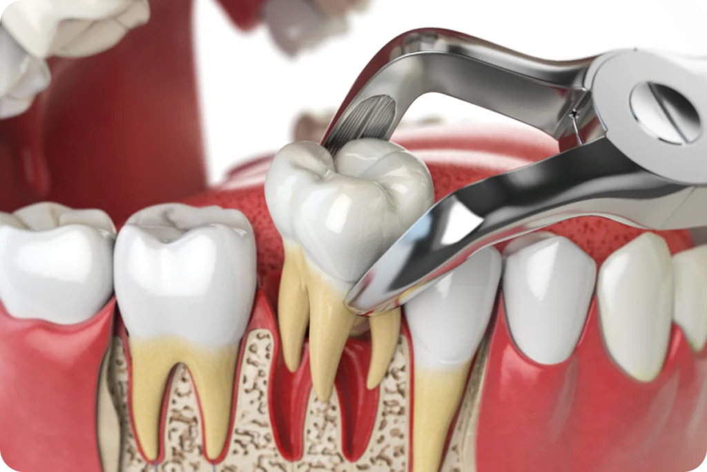 rdv implantation immediate clermont ferrand rdv implantation immediate clermont ferrand Implantation immédiate Dr Pierre Mioche - Dentiste à Clermont-Ferrand
